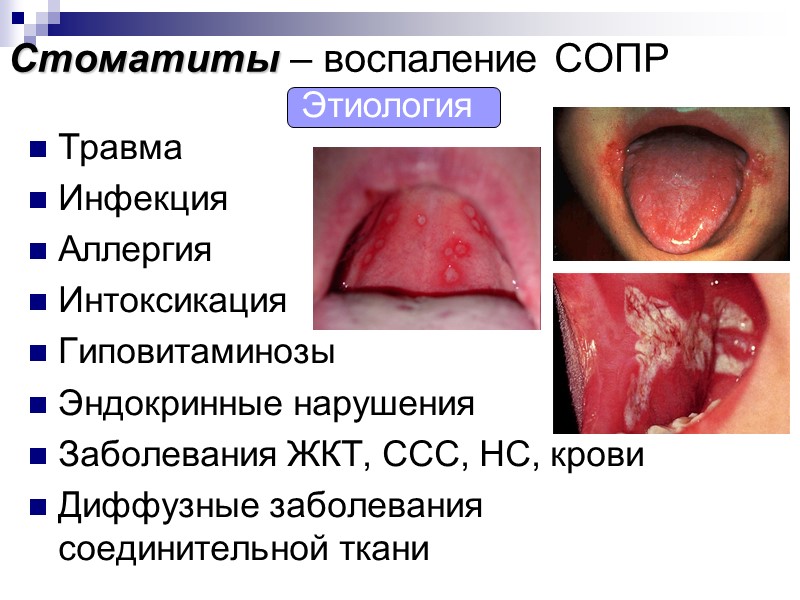Стоматиты – воспаление СОПР Травма Инфекция Аллергия Интоксикация Гиповитаминозы Эндокринные нарушения Заболевания ЖКТ, ССС,